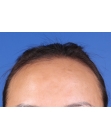 Before Hair Transplant &nbsp;Hairline